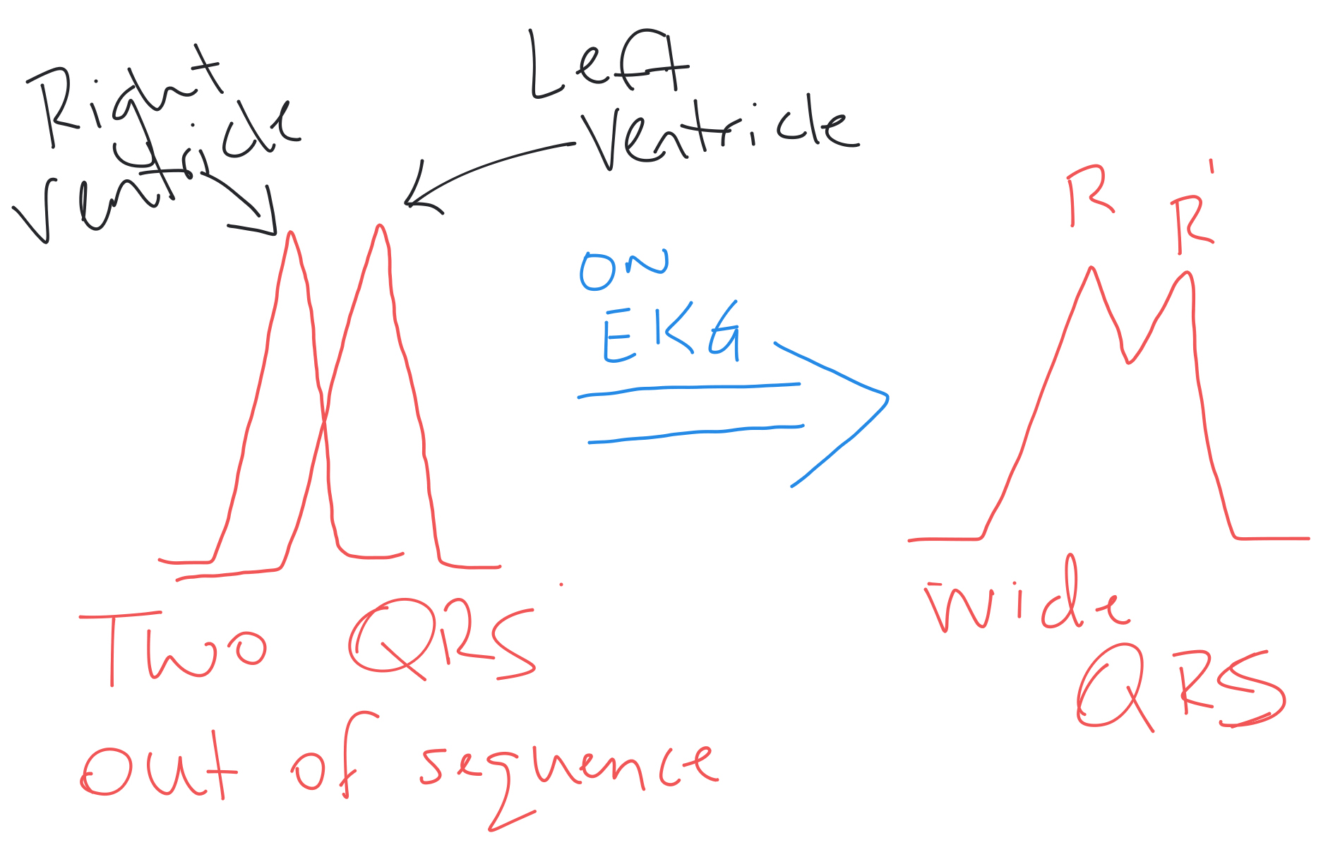 EMTprep   RBBB Explanation 